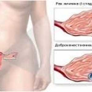 Stadiul de cancer ovarian la femei