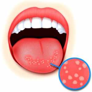 Stomatita: Simptome si tratament