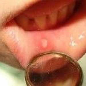 Stomatita la adulți: ce și cum să trateze stomatită în gură?