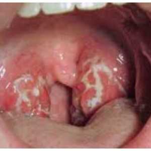 Infecție streptococică a gâtului