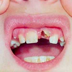 Traumatisme dentare