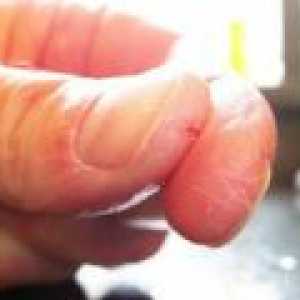 Cracked piele pe mâini - cauze, tratament