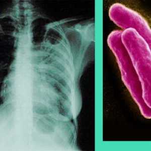 Tuberculoza - semne și simptome de