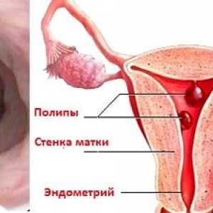 Eliminarea polipilor endometriali: modul în care tratăm