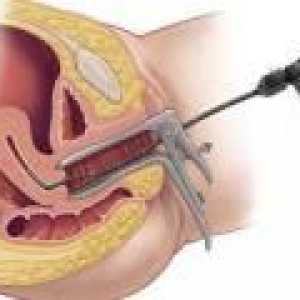 Eliminarea polipi in uter - metode de îndepărtare