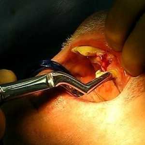 Extracția dentară
