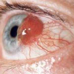 Melanom uveal, sau cancer al ochiului: cum să identifice și să trateze