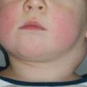 Ganglionilor limfatici de la nivelul gâtului copilului. Cauze si tratament.