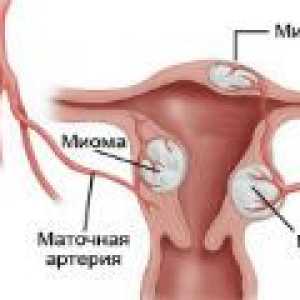 Fibrom uterin nodular - cauze, simptome, tratament