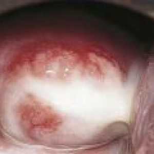 Vaginita la femei - cauze, tratament