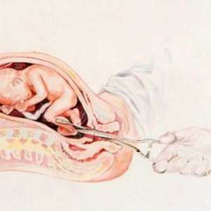 Avort vacuum: termeni