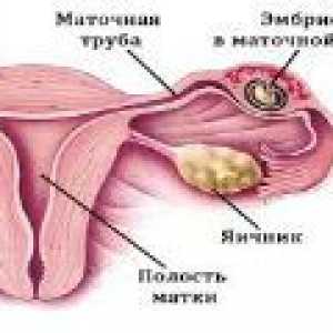 Sarcina extrauterină: simptome, semne, tratament