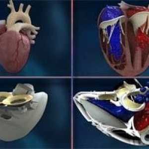 Franceză implantat prima inima artificiala