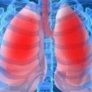 Pneumonie la adulti: simptome, tratament