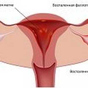 Inflamarea trompelor și ovarelor, cauze, tratament