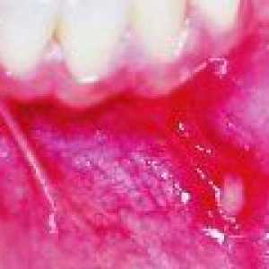 Inflamația cavității orale: cauze, tratament