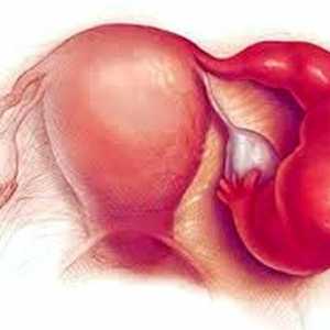 Inflamarea apendicelor la femei: simptome si tratament