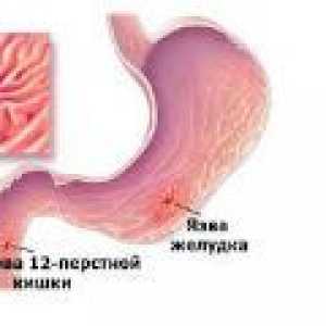 Inflamația stomacului și duodenului