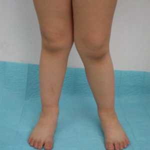 Displazie congenitală a genunchiului