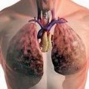 Toate tratamentele de tuberculoză pulmonară