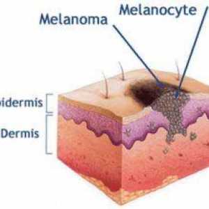 Întregul adevăr despre melanom