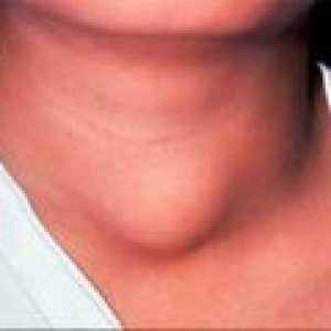 Boli tiroidiene la femei - Tratamentul