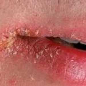 Perleches colțuri ale gurii: simptome, cauze, tratament