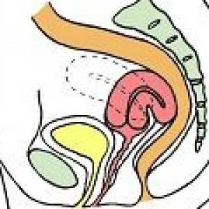 Îndoire a uterului - cauze, simptome, tratament