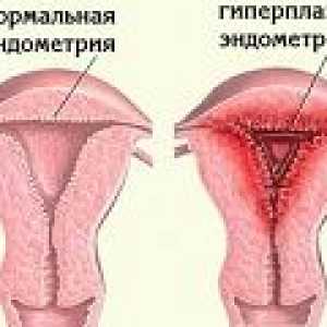Hiperplazie endometrială Glandulocystica