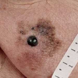 Zlokachesvtennaya lentigo melanom: caracteristici ale bolii și tratamentul